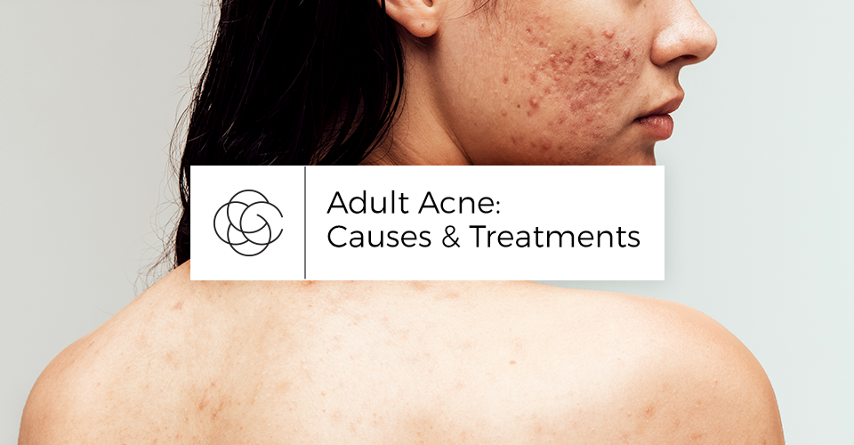 adult acne treatment