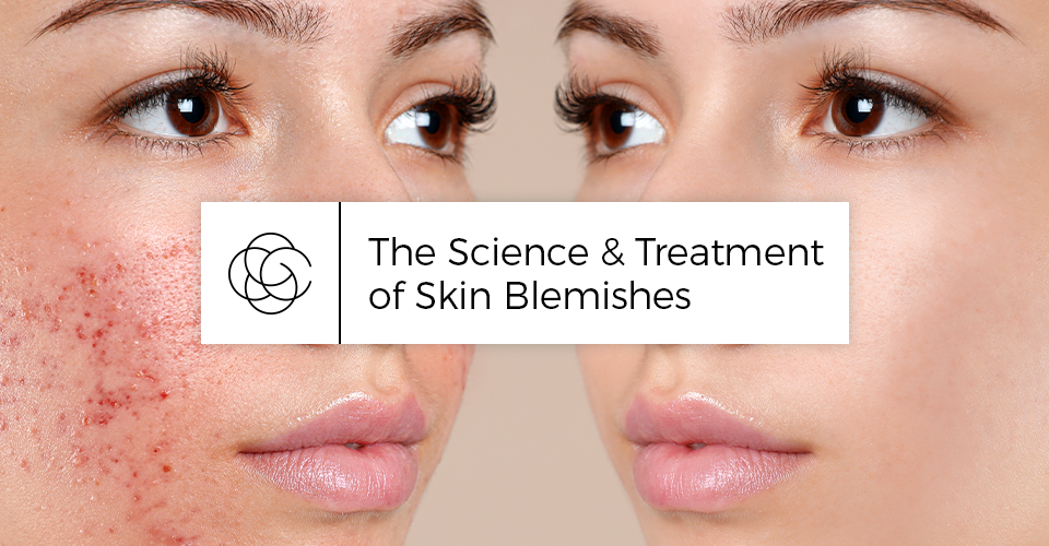 The Science & Treatment of Skin Blemishes